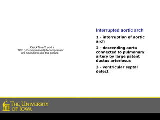Interrupted aortic arch 1 - interruption of aortic arch  2 - descending aorta connected to pulmonary artery by large patent ductus arteriosus 3 - ventricular septal defect 