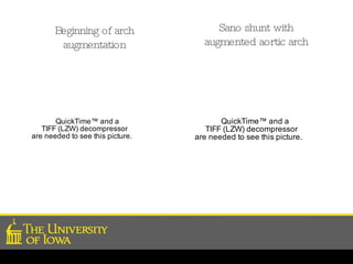 Sano shunt with augmented aortic arch Beginning of arch augmentation 