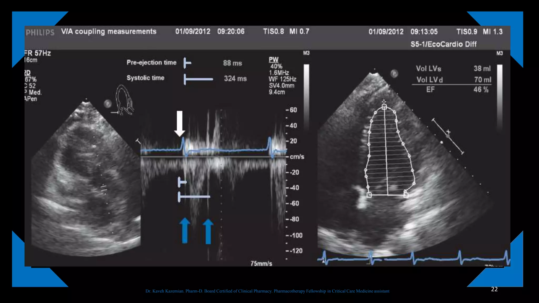 Ventriculo arterial coupling | PPTX