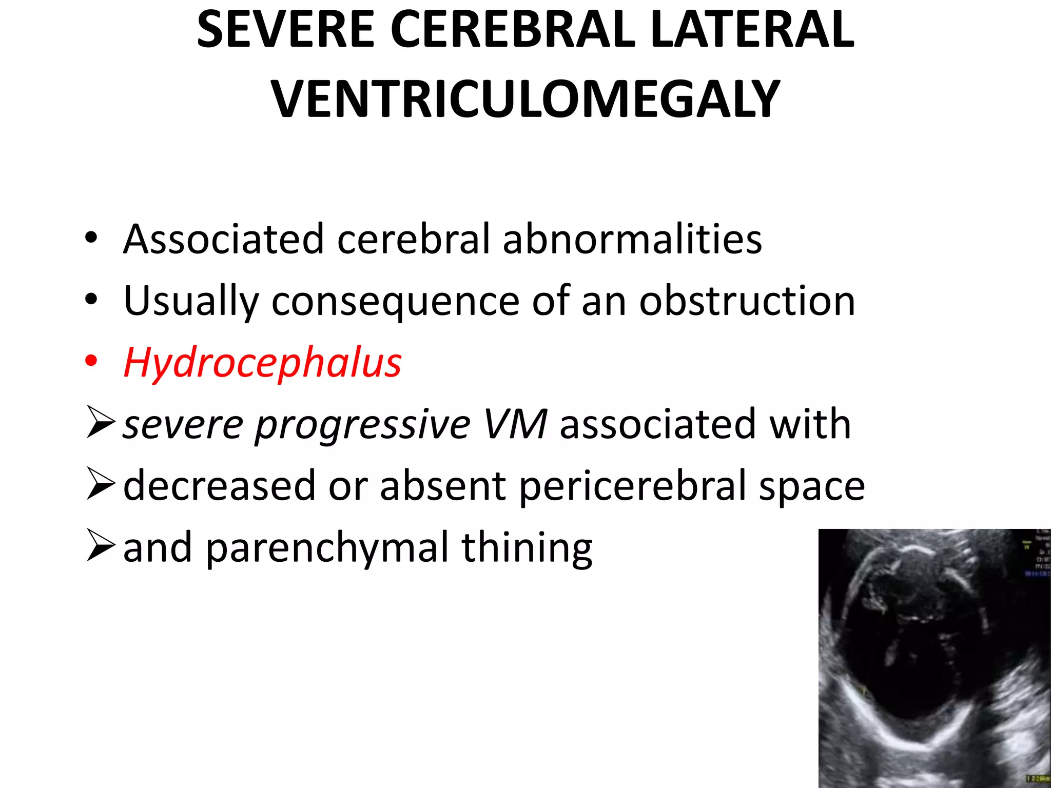 SEVERE CEREBRAL LATERAL
VENTRICULOMEGALY
• Associated cerebral abnormalities
• Usually consequence of an obstruction
• Hydrocephalus
severe progressive VM associated with
decreased or absent pericerebral space
and parenchymal thining
 