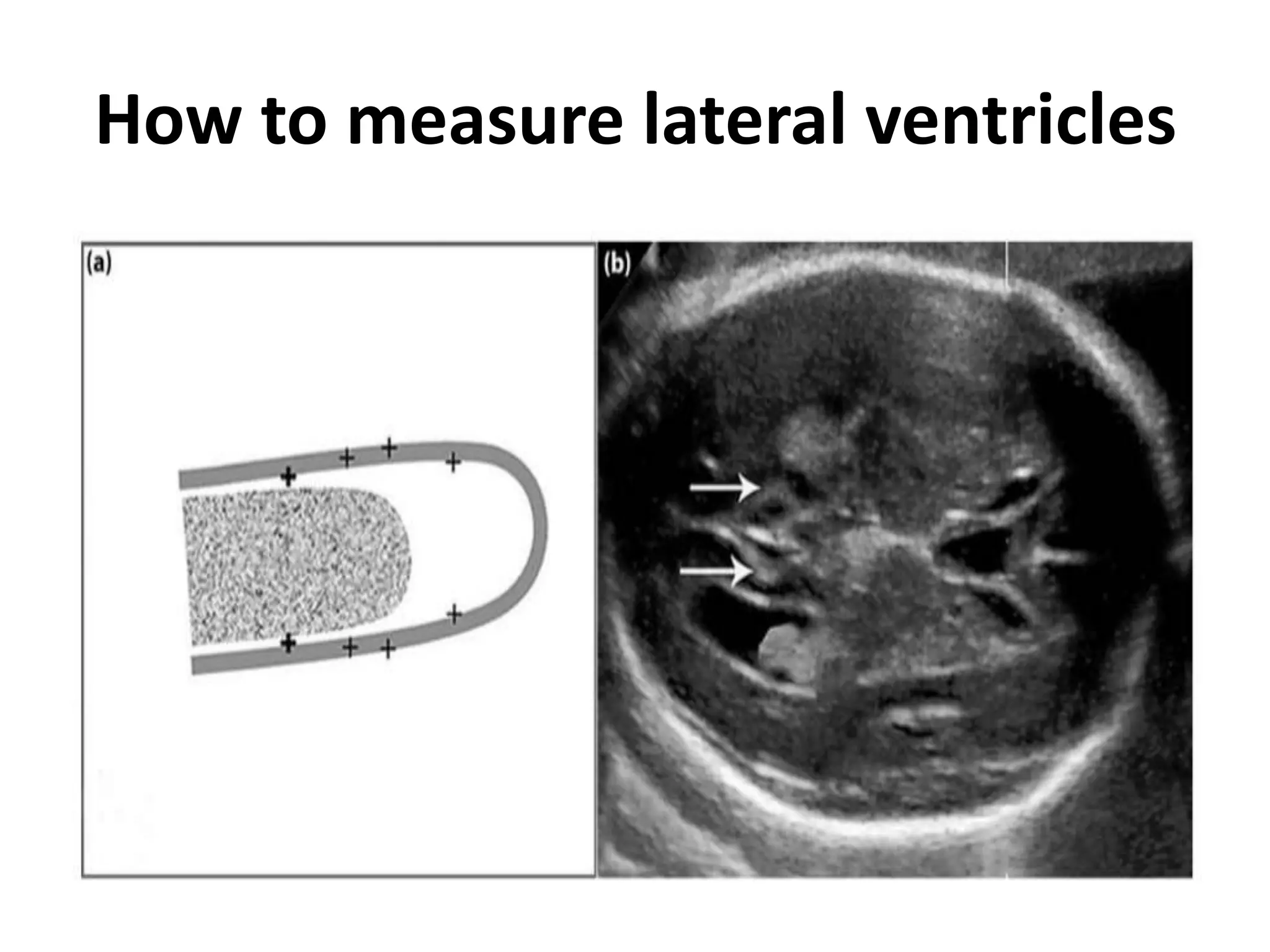 How to measure lateral ventricles
 