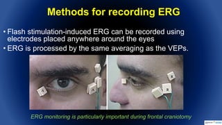 Intraoperative Flash Visual Evoked Potentials | PPTX