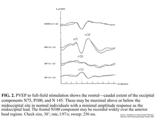 FIG. 2. PVEP to full-field stimulation shows the rostral—caudal extent of the occipital
components N75, P100, and N 145. These may be maximal above or below the
midoccipital site in normal individuals with a minimal amplitude response as the
midoccipital lead. The frontal N100 component may be recorded widely over the anterior
ad . C c , 30 ; a , .97/ ; ; 256 . Source - Guidelines on Visual Evoked Potentials,
American Clinical Neurophysiology Society, 2008
 
