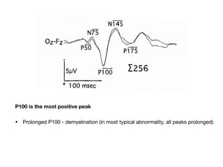 P100 is the most positive peak
• Prolonged P100 - demyelination (in most typical abnormality, all peaks prolonged) 

 