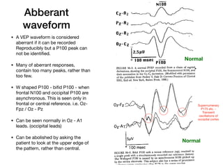 Abberant
waveform
• A VEP waveform is considered
aberrant if it can be recorded
Reproducibly but a P100 peak can
not be identified. 

• Many of aberrant responses,
contain too many peaks, rather than
too few. 

• W shaped P100 - bifid P100 - when
frontal N100 and occipital P100 are
asynchronous. This is seen only in
frontal or central reference. i.e. Oz-
Fpz / Oz - Pz

• Can be seen normally in Oz - A1
leads. (occipital leads)

• Can be abolished by asking the
patient to look at the upper edge of
the pattern, rather than central.
Normal
Normal
Supernumerary
P175 etc. -
Transient
oscillations of
occipital cortex
 