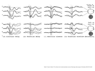 Walsh P, Kane N, Butler S The clinical role of evoked potentials Journal of Neurology, Neurosurgery & Psychiatry 2005;76:ii16-ii22.
 