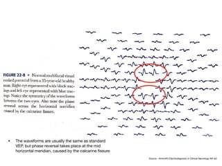 Source - Aminoﬀ’s Electrodiagnosis in Clinical Neurology 6th ed.
• The waveforms are usually the same as standard
VEP, but phase reversal takes place at the mid
horizontal meridian, caused by the calcarine fissure
 