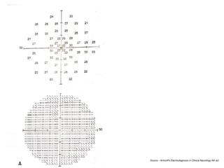 Source - Aminoﬀ’s Electrodiagnosis in Clinical Neurology 6th ed.
 