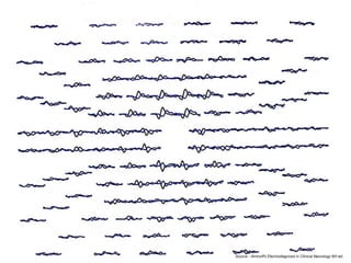 Source - Aminoﬀ’s Electrodiagnosis in Clinical Neurology 6th ed.
 