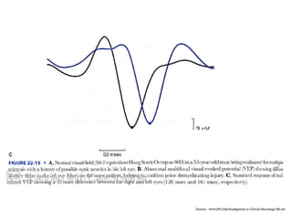 Source - Aminoﬀ’s Electrodiagnosis in Clinical Neurology 6th ed.
 