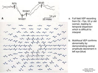 a. Full field VEP recording
from Oz - Fpz, 53 yr old
woman, leading to
temporal dispersion
which is diﬃcult to
interpret

b. Multifocal VEP confirms
abnormality by
demonstrating central
amplitude decrement in
left eye (blue)
Source - Aminoﬀ’s
Electrodiagnosis in Clinical
Neurology 6th ed.
 