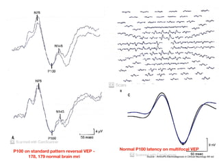 P100 on standard pattern reversal VEP -
178, 179 normal brain mri
Normal P100 latency on multifocal VEP
Source - Aminoﬀ’s Electrodiagnosis in Clinical Neurology 6th ed.
 