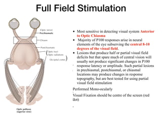 Full Field Stimulation
Left eye Right eye
Chiasm
Chiasm
Prechiasmatic
Postchiasmatic
Optic tract
Optic
nerve
(Optic nerve)
Optic tract
Crossed
(nasal)
fibers
Uncrossed
(temporal)
fibers
Key
Optic radiations
Occipital cortex
Superior
nasal fibers
Superior
Temporal
Nasal
Retinal
fibers
Nasal
Inferior
Temporal
Inferior
nasal fibers
Inferior nasal fibers
decussate in anterior
chiasm and then
project into optic tract
as anterior fibers
Superior view
Optic pathway
(superior view)
with
E.Hatton
• Most sensitive in detecting visual system Anterior
to Optic Chiasma
• Majority of P100 responses arise in neural
elements of the eye subserving the central 8-10
degrees of the visual field.
• Lesions that produce half or partial visual field
deficits but that spare much of central vision will
usually not produce significant changes in P100
response latency or amplitude. Such partial lesions
in prechiasmal, postchiasmal, or chiasmal
locations may produce changes in response
topography, but are best tested for using partial
visual field stimulation
Performed Mono-ocularly
Visual Fixation should be centre of the screen (red
dot)
 