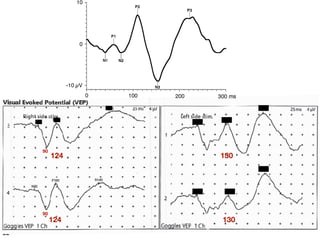 Note that with a
e is recorded Fig. 4 A normal flash VEP
123
124
124
130
130
90
90
 