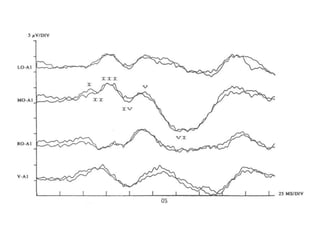 cs often make it difficult to compare specific response components betwe
ubjects.
ash VEP to LED goggle stimulation. Response waveforms may be quite
tency and amplitude abnormalities must be interpreted with caution (see
 