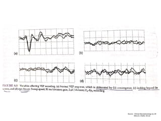 Source - Clinical Neurophysiology by UK
Misra & J Kalita, 3rd ed
 