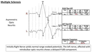 Visual Evoked Potential | PPTX