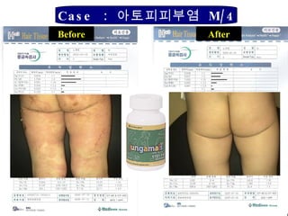 Before After Zn, Ca, Mg   Case  :  아토피피부염  M/4 