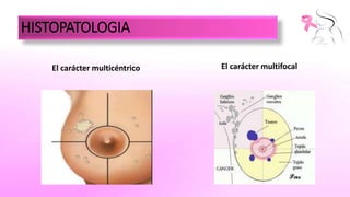 Câncer de mama multifocal/multicêntrico: Perfil clínico