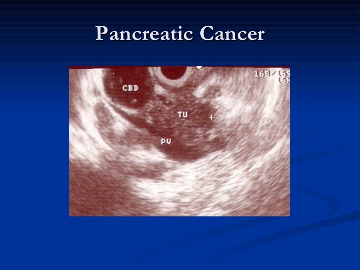download diagnosing pancreatic cancer download diagnosing pancreatic cancer