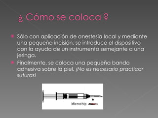 Sólo con aplicación de anestesia local y mediante una pequeña incisión, se introduce el dispositivo con la ayuda de un instrumento semejante a una jeringa. Finalmente, se coloca una pequeña banda adhesiva sobre la piel.  ¡No es necesario practicar suturas!  