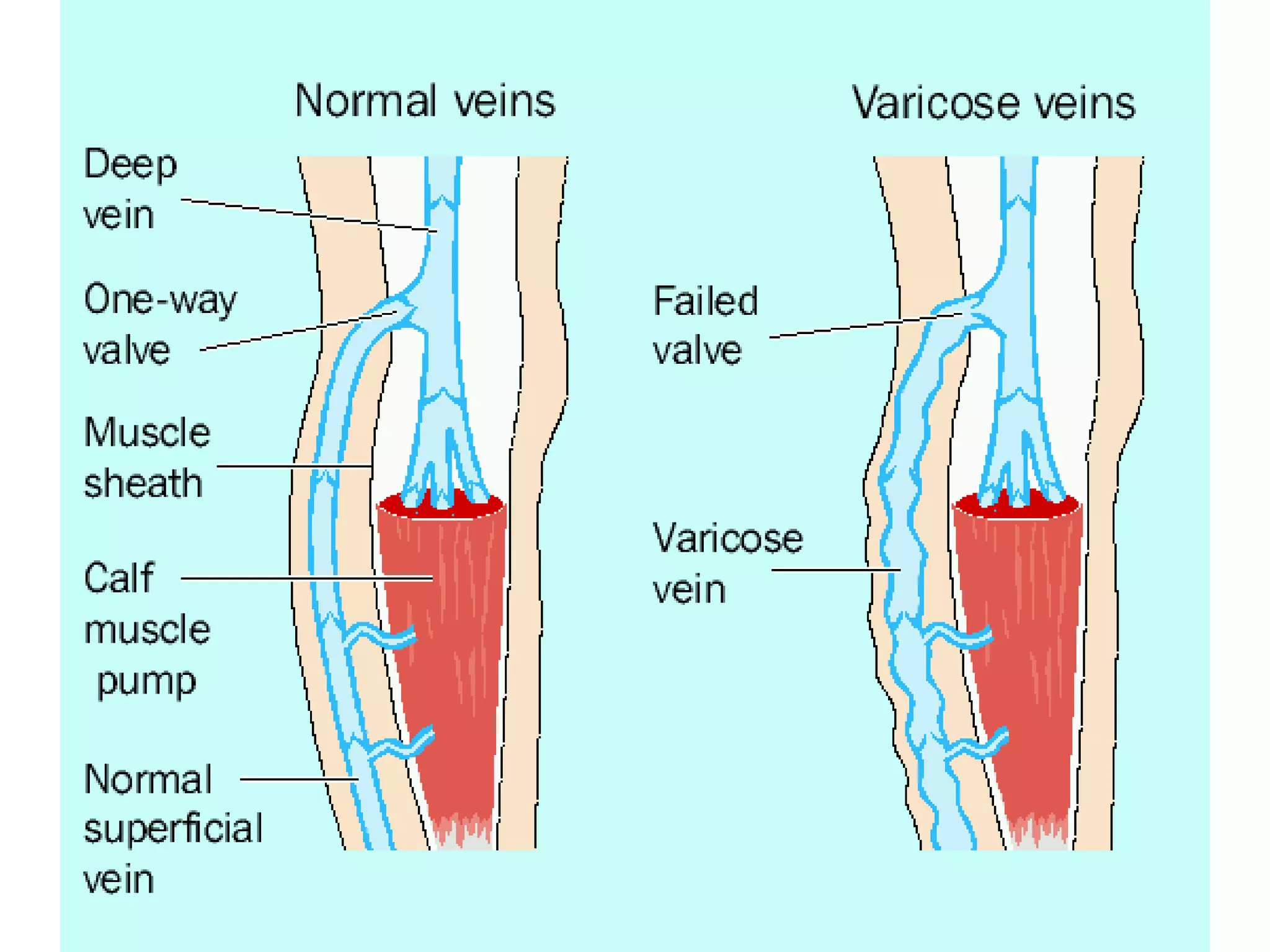 Duplex ultrasound of Vericose vein | PPTX
