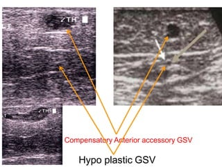 Duplex ultrasound of Vericose vein | PPTX