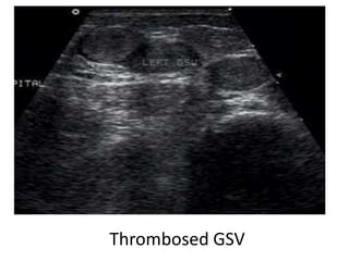 Gsv Course Radiology Duplex ultrasound of Vericose vein | PPTX