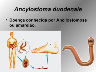 Ancylostoma duodenale
• Doença conhecida por Ancilostomose
ou amarelão.
 