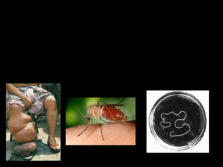 Filária
• Causam filariose, também conhecida como
elefantíase;
• Transmitida por mosquitos do gênero Culex,
vivem no sistema linfático, que é um
conjunto de vasos finos que ajudam a levar
os líquidos dos tecidos de volta à circulação.
 