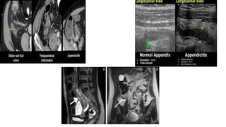 VERMIFORM APPENDIX in detai with surgical amangemntl.pptx
