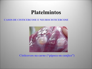 Platelmintos
CASOS DE CISTICERCOSE E NEUROCISTICERCOSE




         Cisticercos na carne (“pipoca ou canjica”)
 