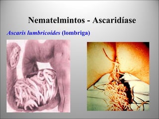 Nematelmintos - Ascaridíase
Ascaris lumbricoides (lombriga)
 