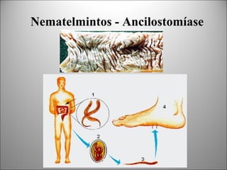 Nematelmintos - Ancilostomíase
 