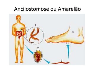 Ancilostomose ou Amarelão
 