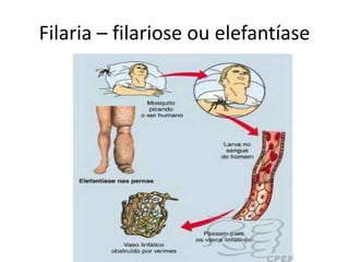 Filaria – filariose ou elefantíase
 