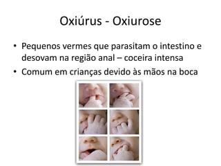 Oxiúrus - Oxiurose
• Pequenos vermes que parasitam o intestino e
desovam na região anal – coceira intensa
• Comum em crianças devido às mãos na boca
 