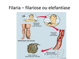 Filaria – filariose ou elefantíase
 