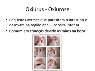 Oxiúrus - Oxiurose
• Pequenos vermes que parasitam o intestino e
desovam na região anal – coceira intensa
• Comum em crianças devido às mãos na boca
 