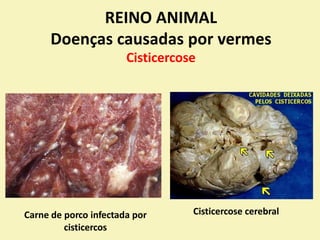 REINO ANIMAL
Doenças causadas por
Cisticercose
vermes
Cisticercose cerebral
Carne de porco infectada por
cisticercos
 
