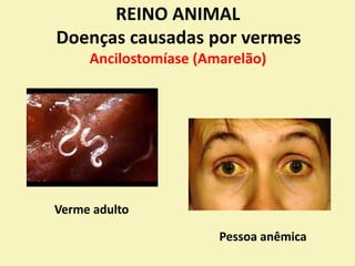 REINO ANIMAL
Doenças causadas por vermes
Ancilostomíase (Amarelão)
Verme adulto
Pessoa anêmica
 