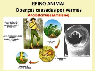 REINO ANIMAL
Doenças causadas por vermes
Ancilostomíase (Amarelão)
 