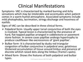 Clinical Manifestations 
Symptoms- VKC is characterized by marked burning and itchy 
sensations which may be intolerable a...