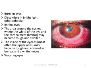  Burning eyes 
 Discomfort in bright light 
(photophobia) 
 Itching eyes 
 The area around the cornea 
where the white...