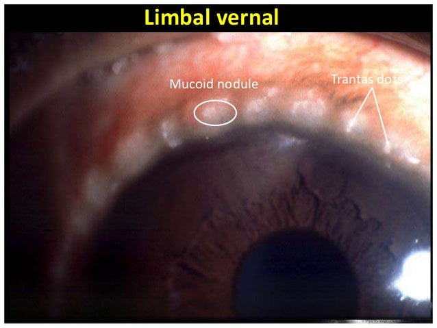 KONJUNGTIVITIS VERNAL PDF DOWNLOAD KONJUNGTIVITIS VERNAL PDF DOWNLOAD