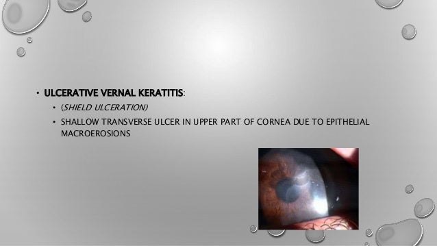 Vernal keratoconjunctivitis ophthalmology