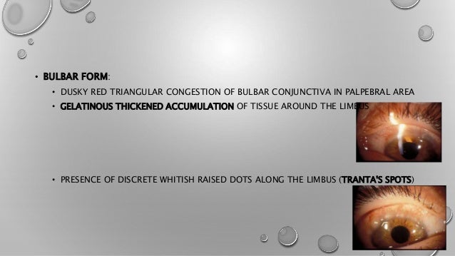 Vernal keratoconjunctivitis ophthalmology