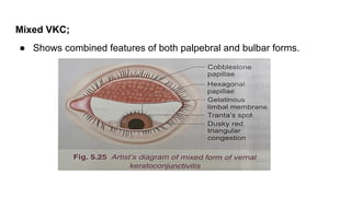Vernal keratoconjunctivitis ophthalmology .pptx