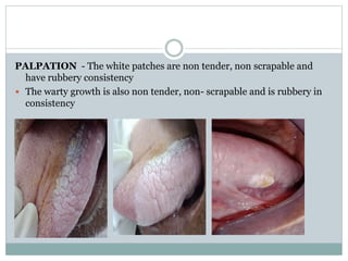 PALPATION - The white patches are non tender, non scrapable and
have rubbery consistency
 The warty growth is also non tender, non- scrapable and is rubbery in
consistency
 