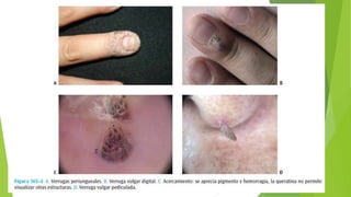 Verrugas (planas, acuminadas, plantares, vulgares) | PPTX